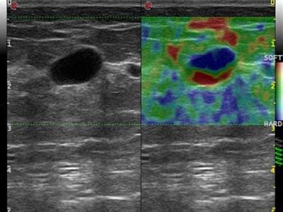 Elastography Breast - JK Scan & Labs