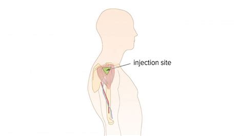 Im Injection Sites Diagram Thigh Injections Intramuscular