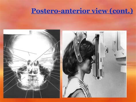 Extra Oral Radiology Techniques Ii Ppt