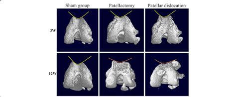 Three Dimension Reconstruction Of The Distal Femur By Micro Ct Scan At