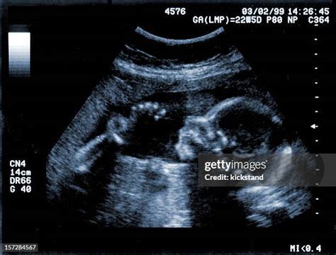 2,604 Ultrasound Fetus Stock Photos, High-Res Pictures, and Images ...