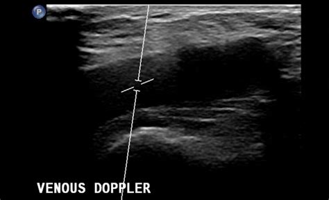 Vascular Doppler Scan Ultrasound Scan