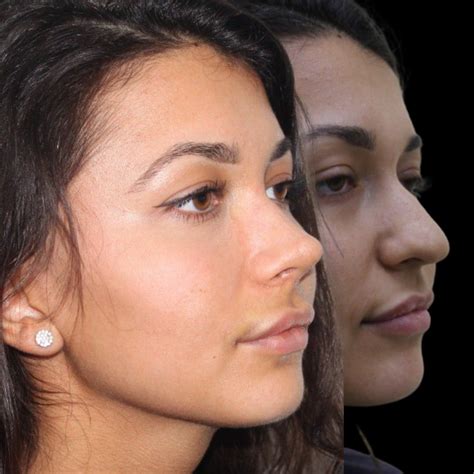 Rhinoplasty Before And After Photos Forbest Clinic