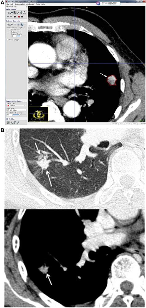 Frontiers Correlation Analysis Between Unenhanced And Enhanced Ct Radiomic Features Of Lung