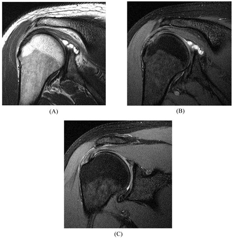 Labrum Tear Mri