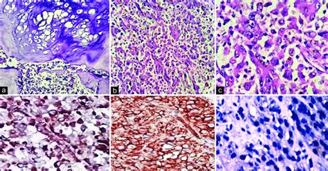 A Histopathology Showed Lowgrade Chondrosarcoma Permeating Into