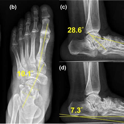 Ankle Lateral Radiography Weight Bearing View A Postoperative Download Scientific Diagram