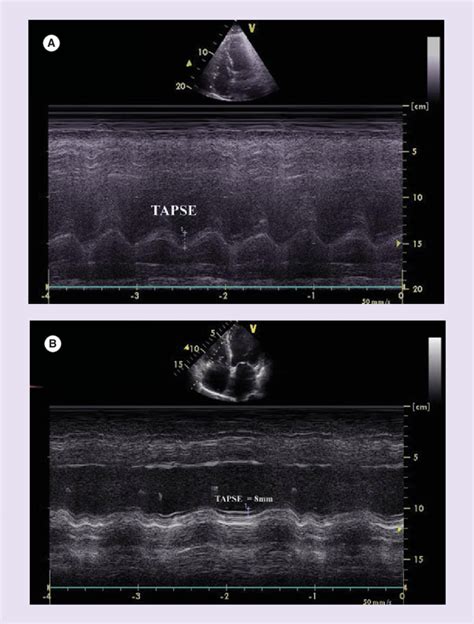 Echocardiographic Assessment Of The Right Ventricle A Normal Heart