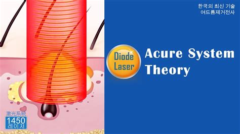 Acure System Diode Laser Energy Theory YouTube