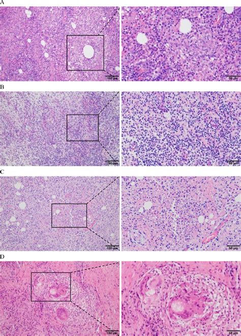 Etiology Of Granulomatous Lobular Mastitis Based On Metagenomic Next