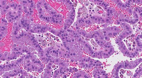 Carcinoma Papilar De C Lulas Renales Mypathologyreport Ca