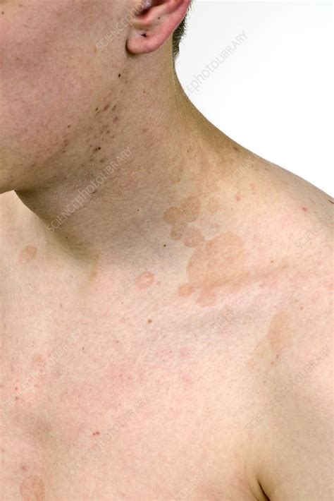 All About Tinea Versicolor Causes Treatment And Prevention Off