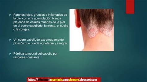 Conoce La Psoriasis Cuero Cabelludo Y Como Tratarla Ppt