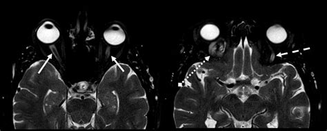 Thrombosed Orbital Varix With Mild Spontaneously Resolving Symptoms In