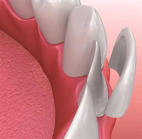 Lumineers - T Clinic Manchester | Dentistry You Deserve