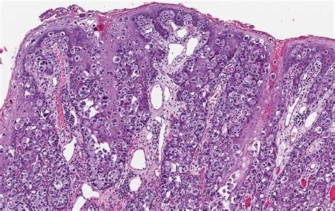 Pathology Outlines Paget Disease