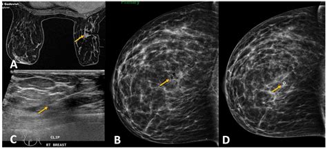 Challenges in MRI-Guided Breast Biopsy and Some Suggested Strategies