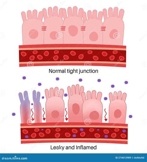 Leaky Gut Intestinal Permeability Gut Barrier Dysfunction Vector