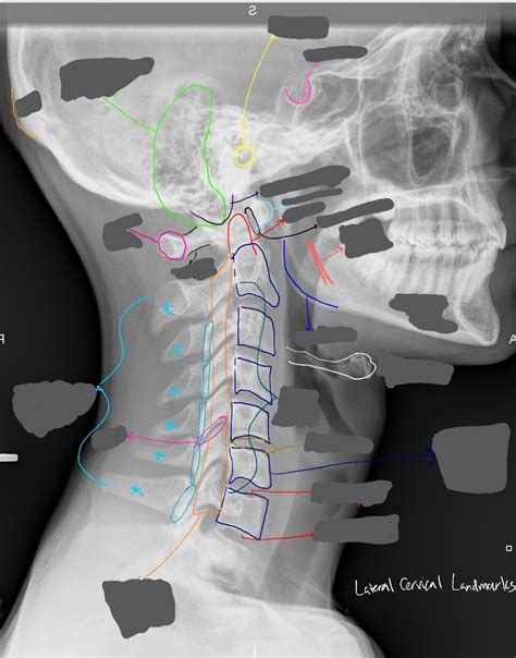 Lateral Cervical Landmarks Diagram Quizlet