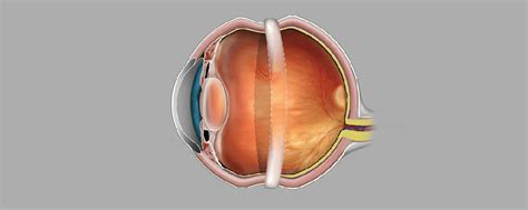 Retinal detachment treatment by Scleral Buckling | Basir Eye Center