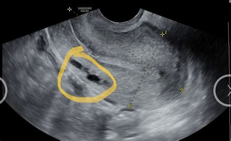 O Que Pode Ser Mancha No Utero