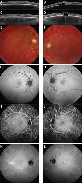 Unilateral Central Serous Chorioretinopathy And Bilateral Retinal