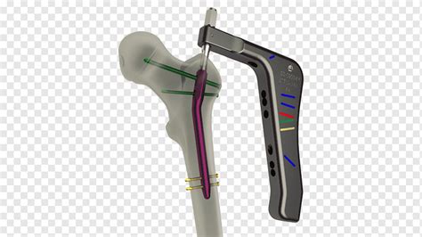 Femur Intramedullary Rod Femoral Fracture Hip Fracture Anatomy