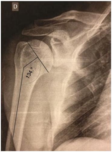 Scielo Brasil Impacted Valgus Fractures Of The Proximal Humerus