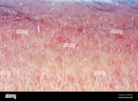 Dry Skin View Of Dry Flaking Skin On A Persons Leg While Skin Is