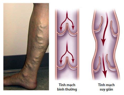 Tìm hiểu hình ảnh suy giãn tĩnh mạch chân để tránh tình trạng này