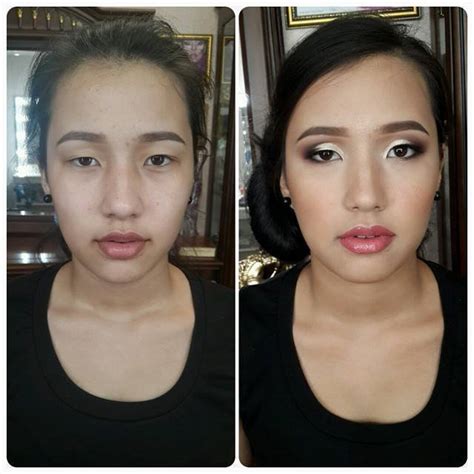 how to fix eyelid asymmetry