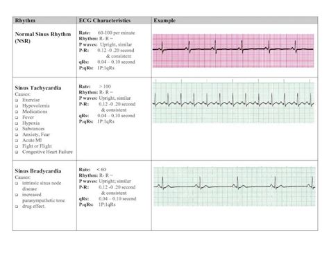 Pdf Rhythm Ecg Characteristics Example Ems Study Guideemsseo Wp