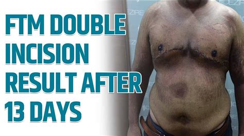 Female To Male Top Surgery Result After Days Double Incision Youtube