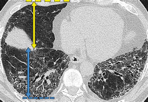 visual  automated ct measurements  lung volume loss  idiopathic