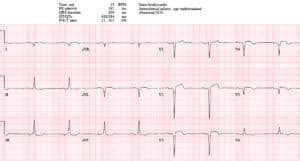 ECG Cases 14: Q-waves and Occlusion MI | EM Cases