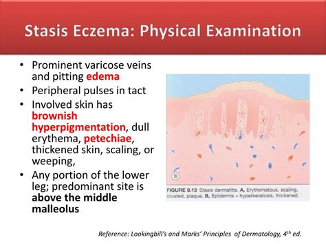 Ppt Nummular Dermatitis Powerpoint Presentation Free Download Id1984781