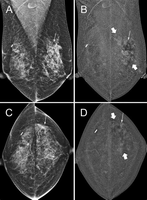 A And C Year Old Patient D Surveillance Images Md Birads C