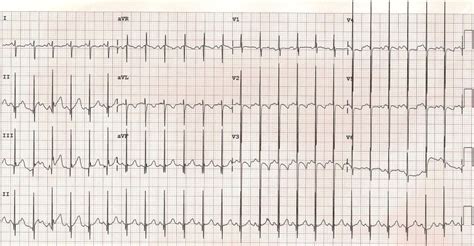 ECG and CXR in ventricular septal defect – All About Cardiovascular ...