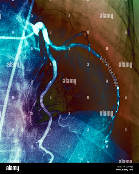 Coronary Stent X Ray Stock Photo Alamy