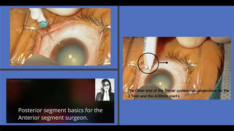 Post Seg Basics For The Ant Seg Surgeon How To Insert The Trocar