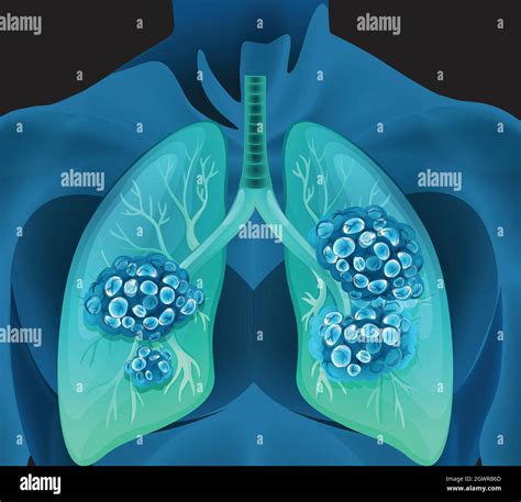 Lung Cancer In Human Body Stock Vector Image And Art Alamy