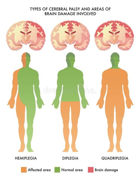 Medicinsk Illustration Av Olika Typer Av Cerebral Pares Vektor