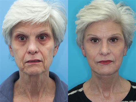 Top Facelift Scottsdale Arizona Wolin Plastic Surgery Center