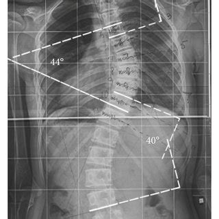 Cobb angle measurement method. | Download Scientific Diagram