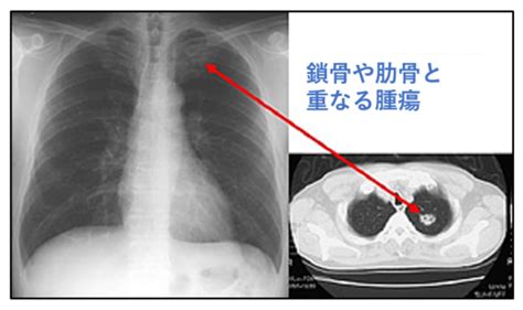 低線量肺がんct検診 【公式】かとう内科・呼吸器クリニック