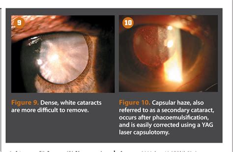 Cataracts Types