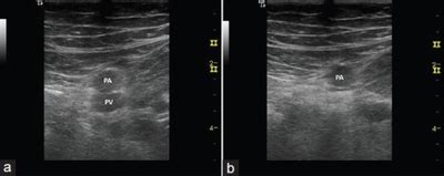 DVT ultrasound - WikEM