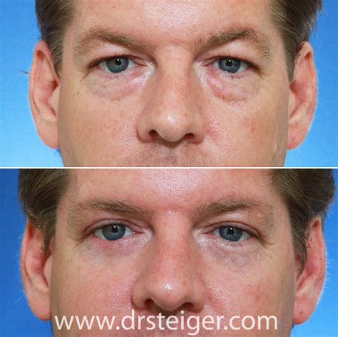 Blepharoplasty Eyelid Surgery Photos Before And After