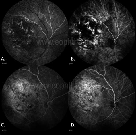 Choroidal Melanoma Fluorescein Angiography