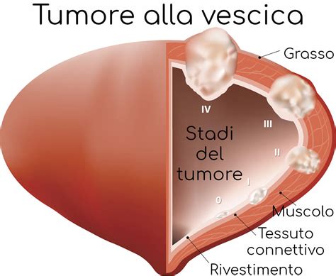 Tumore Alla Vescica Sintomi Sopravvivenza Diagnosi E Cure